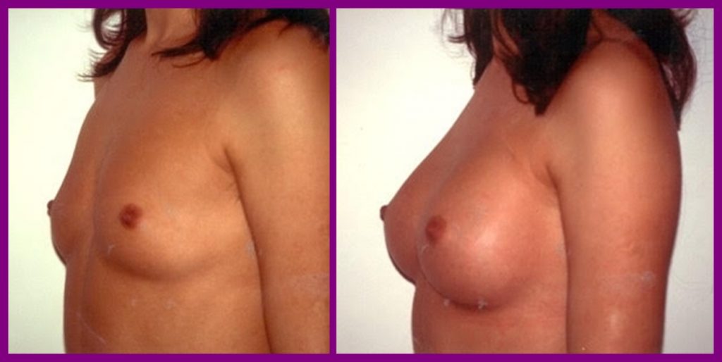 Mastoplastica Additiva (aumento del volume del seno)