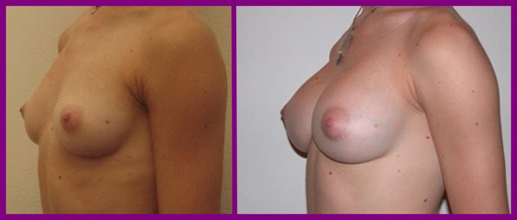 Mastoplastica Additiva (aumento del volume del seno)